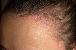 scar revision surgery in bangalore